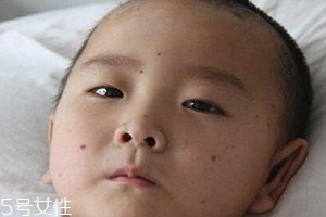 痣什么情況下會(huì)轉(zhuǎn)變?yōu)榱?？點(diǎn)痣不可取