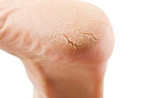 冬天裂腳怎么辦？5招緩解裂腳