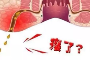 肛瘺非手術(shù)治療才可以嗎？手術(shù)是治療的關(guān)鍵途徑