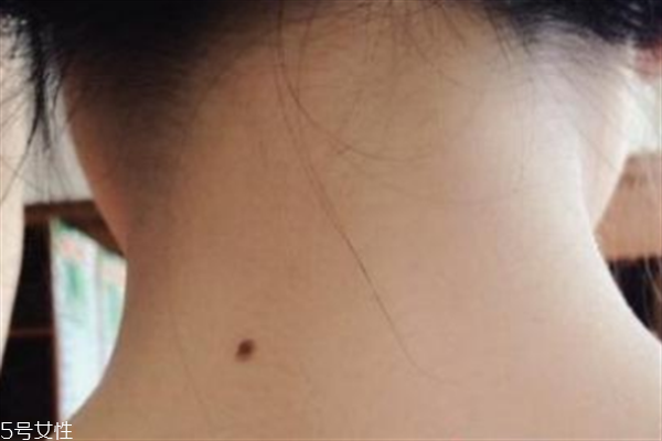 脖子后面有痣好嗎？激光冷凍祛痣易導致癌變