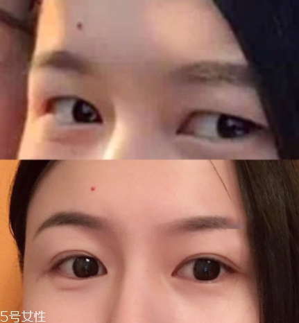 內(nèi)雙怎么進(jìn)化成雙眼皮？全是雙眼皮貼的功勞