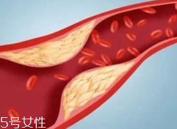 血管堵塞怎么自查？腿腳告訴你答案