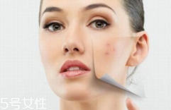 痘印多久能自行消失？多數(shù)人一年內(nèi)消失