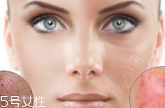 痘印多久能自行消失？多數(shù)人一年內(nèi)消失