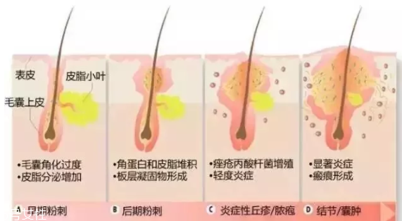 封閉性粉刺的發(fā)病機(jī)制是什么？角質(zhì)層太厚