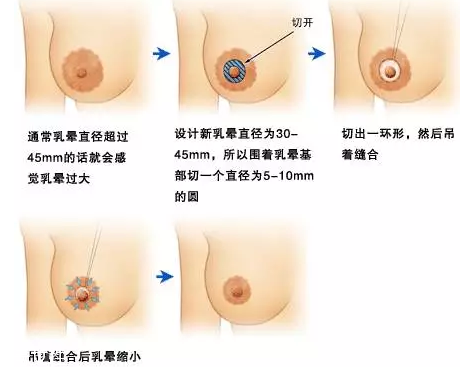 乳暈縮小術(shù)怎么做？乳暈縮小術(shù)知識(shí)全解