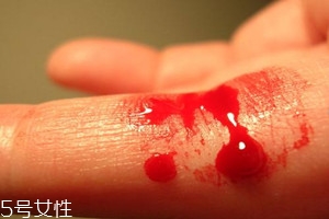 血友病的主要表現(xiàn)有哪些？出血是最明顯的特征