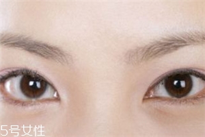 割雙眼皮后怎樣恢復(fù)快？女人不能割雙眼皮的時期