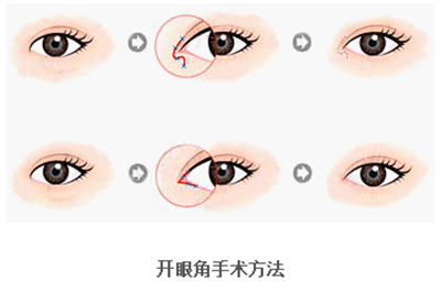 開(kāi)眼角疤痕多久消失？開(kāi)眼角的適宜人群