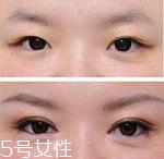 開(kāi)眼角疤痕多久消失？開(kāi)眼角的適宜人群