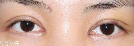 怎么縮短開眼角疤痕消失時(shí)間？雙眼皮開眼角恢復(fù)過程