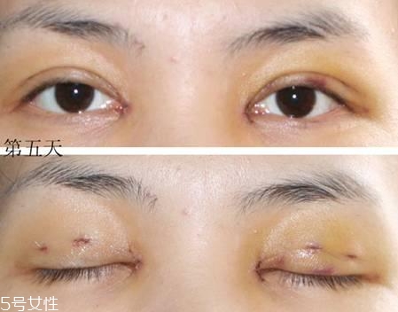 怎么縮短開眼角疤痕消失時(shí)間？雙眼皮開眼角恢復(fù)過程