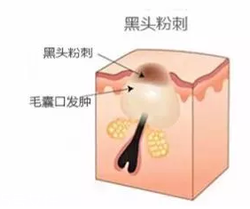 閉口是怎么引起的？4種情況要注意