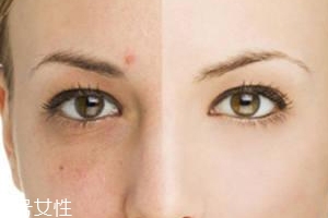 祛痘產(chǎn)品怎么選？先要分清痘印類型