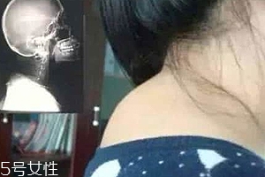 富貴包是什么病？姿態(tài)優(yōu)美少犯病