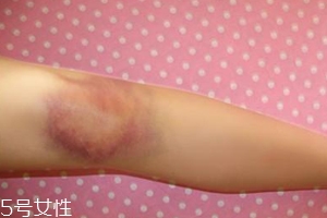 身體淤青怎么來的？不是磕碰那么簡單