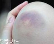 身體淤青怎么來的？不是磕碰那么簡單