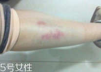 身體淤青怎么來的？不是磕碰那么簡單