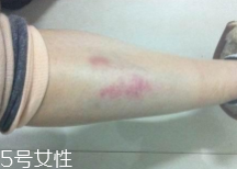 摔傷了涂什么藥好的快？做好消毒才能愈合快