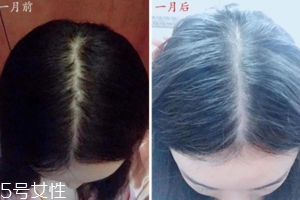柳屋生發(fā)水有用嗎？一個(gè)月后長(zhǎng)出新發(fā)