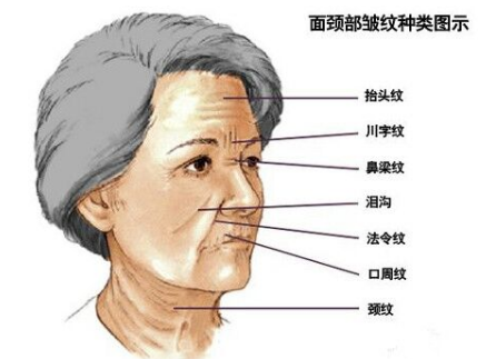 川字紋可以打玻尿酸嗎？不是最佳選擇