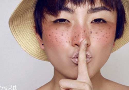 祛斑反彈是什么原因？一定沒(méi)注意這4點(diǎn)
