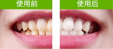牙貼怎么分上下牙貼？牙貼怎么分正反