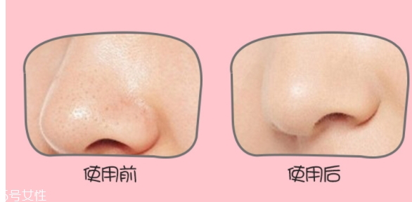 yoii黑頭儀怎么用？yoii黑頭儀怎么充電