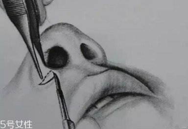 鼻翼外切多久消腫？鼻翼外切消腫時(shí)間要多長？