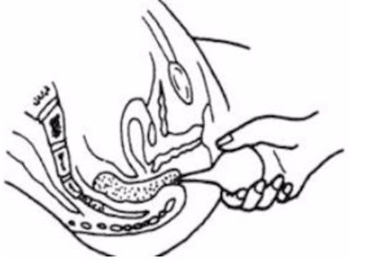 開(kāi)塞露躺著還是蹲著用？開(kāi)塞露使用姿勢(shì)