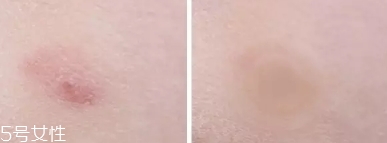 vt痘痘貼怎么用？vt老虎痘痘貼防水嗎