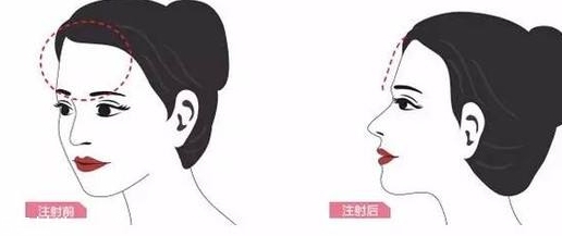 豐額頭多少錢(qián) 豐額頭要打多少針