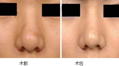 縮鼻手術多久恢復？縮鼻手術傷口才會好