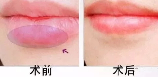 厚唇變薄術(shù)注意事項 厚唇變薄術(shù)術(shù)后護(hù)理
