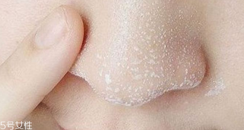 黑頭不管它會變大嗎？黑頭不管它會怎樣？