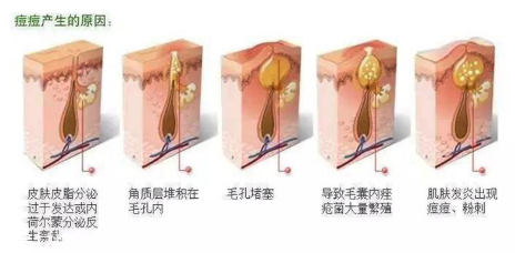 頑固痘痘怎么消除？油皮為什么反復(fù)爆痘？