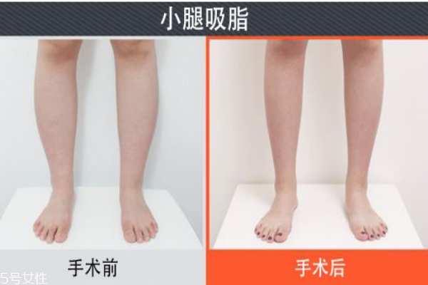 小腿吸脂后遺癥你知道多少？