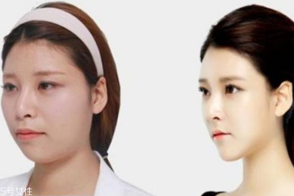 削骨多少錢(qián) 整骨適合人群