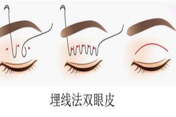 埋線雙眼皮感染怎么辦？埋線雙眼皮發(fā)炎了怎么辦