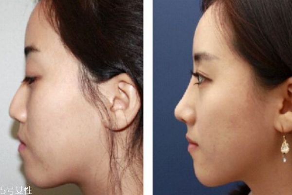 達拉斯隆鼻和普通隆鼻有什么區(qū)別 達拉斯隆鼻前后圖