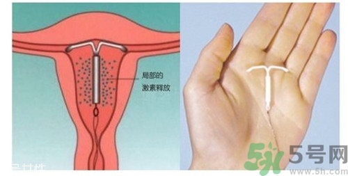 上環(huán)是什么意思？上環(huán)后注意事項有哪些？
