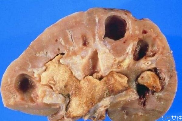 腎結(jié)石嚴重嗎 腎結(jié)石多大需要碎石