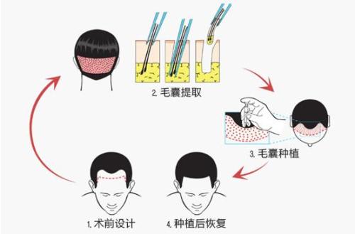 自體毛發(fā)種植多少錢(qián) 自體毛發(fā)種植哪一步最關(guān)鍵