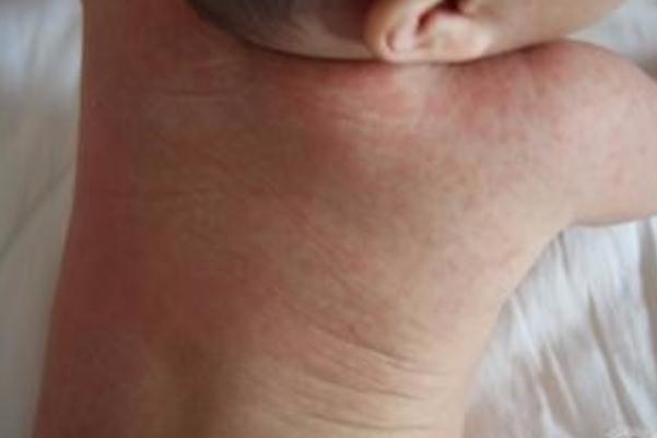 寶寶長痱子有點化膿了怎么辦 寶寶長痱子會癢嗎