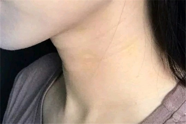 頸紋和胖瘦有關(guān)系嗎 頸紋是因為胖才有的嗎