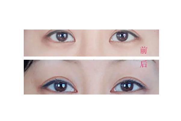 開(kāi)眼角要多久拆線 開(kāi)眼角有什么危險(xiǎn)嗎