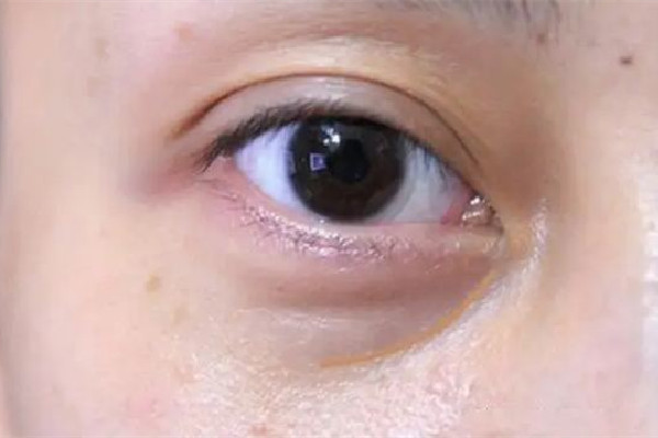 武漢淚溝填充哪家比較好 武漢哪家醫(yī)院淚溝修復好