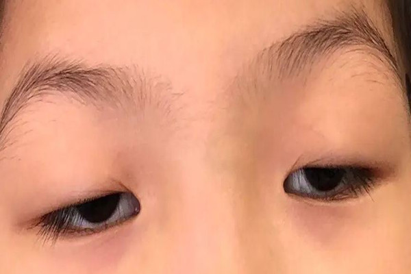 武漢上眼瞼下垂哪個醫(yī)院做的好 武漢上眼瞼下垂修復手術(shù)要多少錢