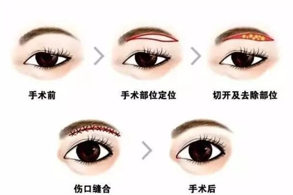 武漢提眉手術哪個醫(yī)院做的好 武漢提眉手術需要多少錢