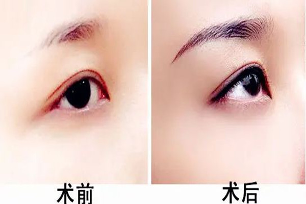 武漢提眉手術哪個醫(yī)院做的好 武漢提眉手術需要多少錢